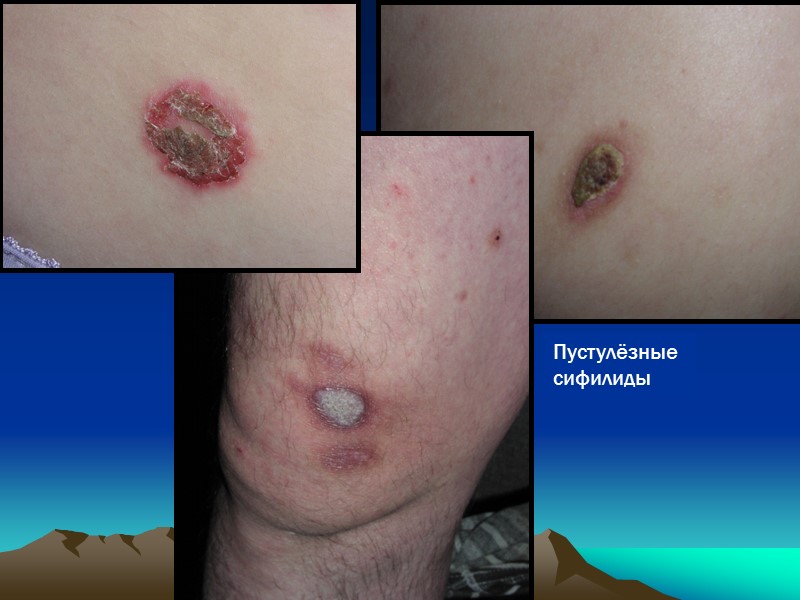 Пустулёзные сифилиды